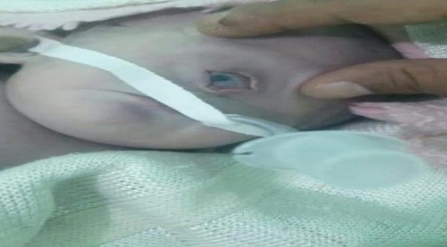 
                      شاهد بالصور.. ولادة طفل بعين واحدة لأول مرة في اليمن