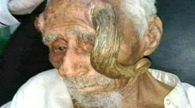
                     المُعمّر اليمني الذي عاش 140 عامًا ومات بخطأ طبي..ماقصته؟ 
